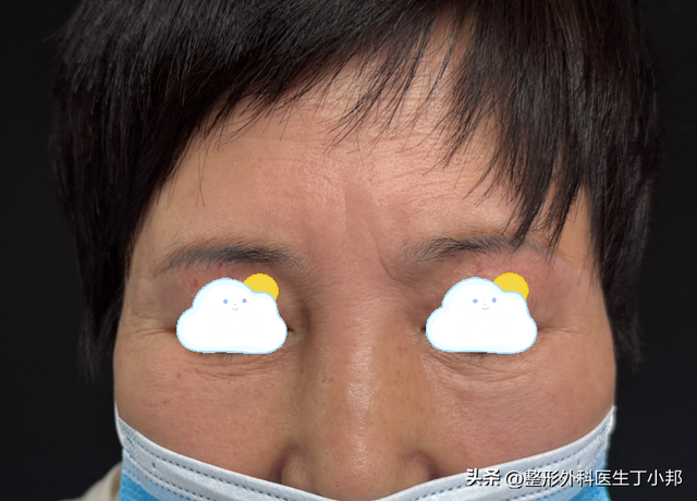 50岁女士13年间反复做鼻部整形，把鼻子整成“通天鼻”来取出异物