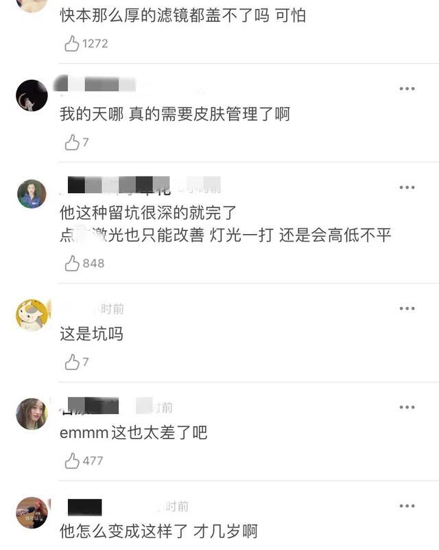 王源皮肤再引争议！快本镜头下脸部凸点明显，磨皮滤镜也挡不住