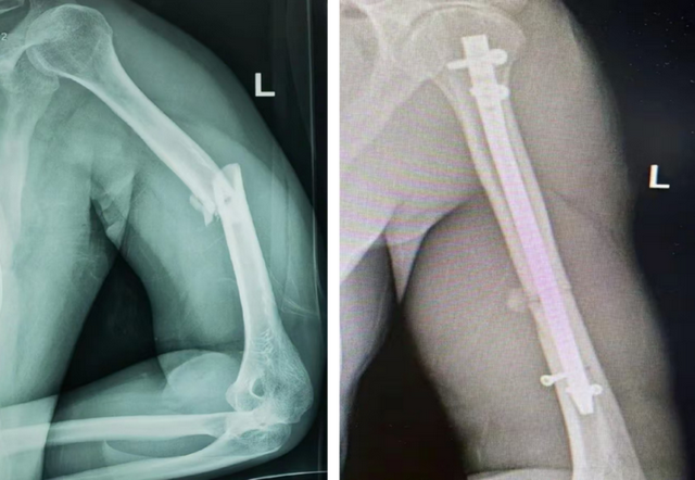 引领骨科新纪元：髓内钉微创技术，重塑四肢骨折治疗新标准
