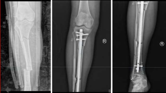 引领骨科新纪元：髓内钉微创技术，重塑四肢骨折治疗新标准