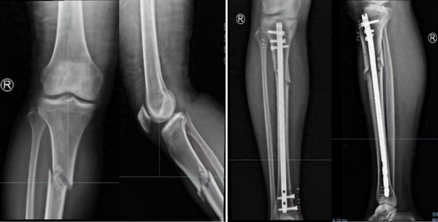 引领骨科新纪元：髓内钉微创技术，重塑四肢骨折治疗新标准