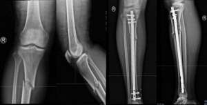 赵滨(引领骨科新纪元：髓内钉微创技术，重塑四肢骨折治疗新标准)