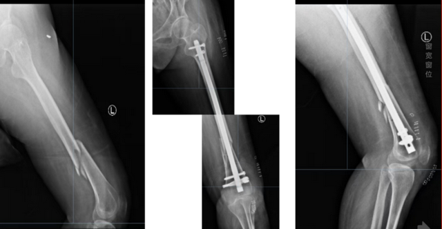 引领骨科新纪元：髓内钉微创技术，重塑四肢骨折治疗新标准