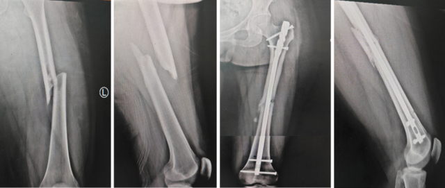 引领骨科新纪元：髓内钉微创技术，重塑四肢骨折治疗新标准