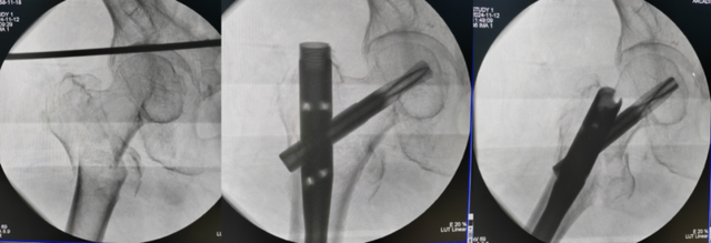 引领骨科新纪元：髓内钉微创技术，重塑四肢骨折治疗新标准