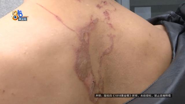 颜值主播拔火罐，酒精烧了起来，她说“当时感觉毁了”