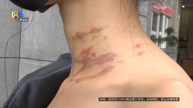 颜值主播拔火罐，酒精烧了起来，她说“当时感觉毁了”