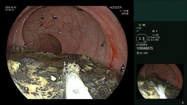 一女子半夜狂“炫”百香果籽，半夜肚子痛进医院