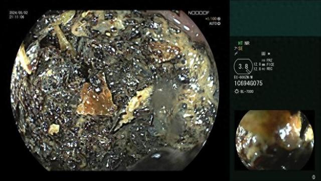 一女子半夜狂“炫”百香果籽，半夜肚子痛进医院