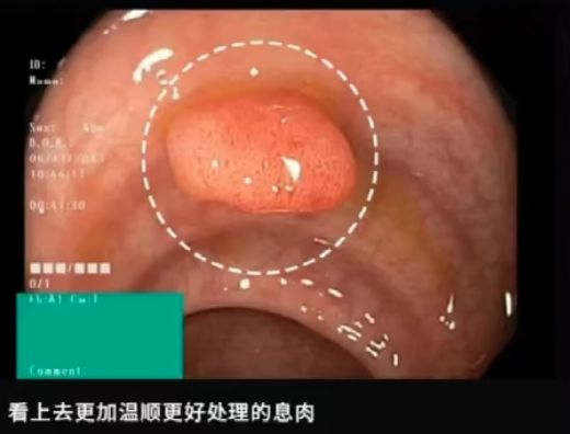 这种息肉可能会变成癌!排便出现这4种异常建议及时就医