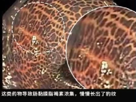 这种息肉可能会变成癌!排便出现这4种异常建议及时就医