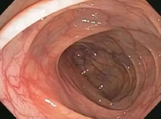 这种息肉可能会变成癌!排便出现这4种异常建议及时就医