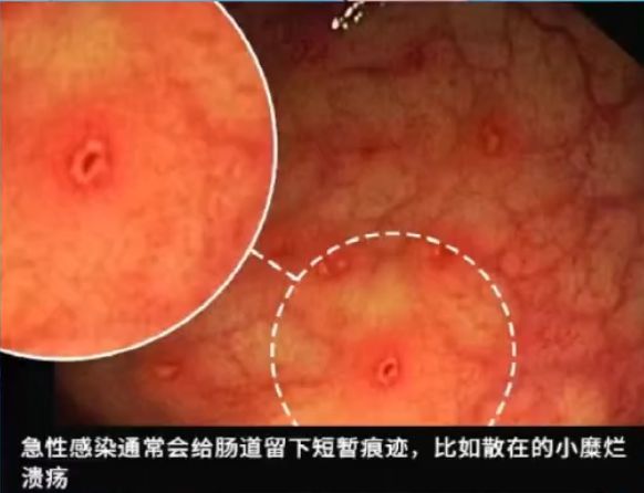 这种息肉可能会变成癌!排便出现这4种异常建议及时就医