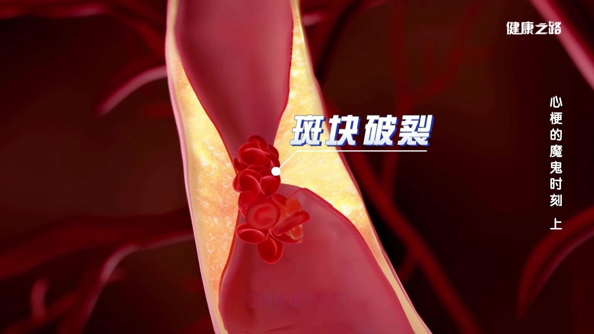 突发心梗趋于年轻化 急救指南一定要看→